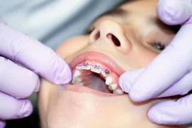 orthodontics facts dentist Sugar Hill